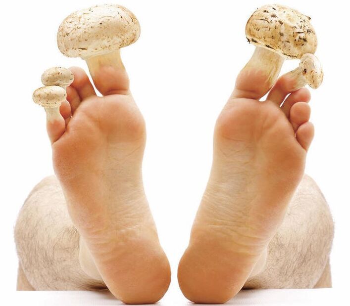 Gljivice stopala i noktiju