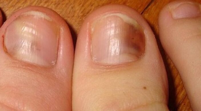 gljivična infekcija noktiju