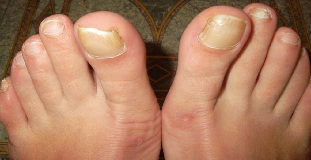 rane faze gljivica noktiju na nogama