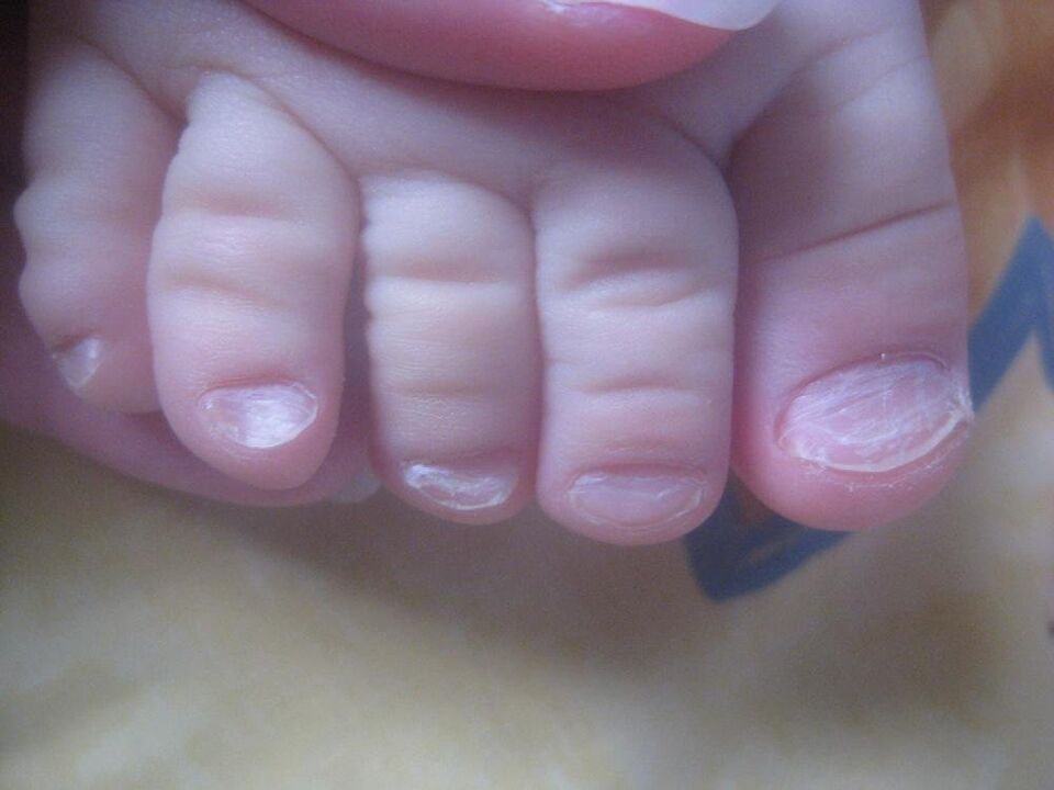 gljivice na noktima na nogama kod djece