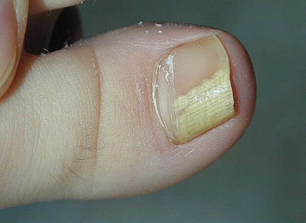 simptomi gljivica noktiju na nogama