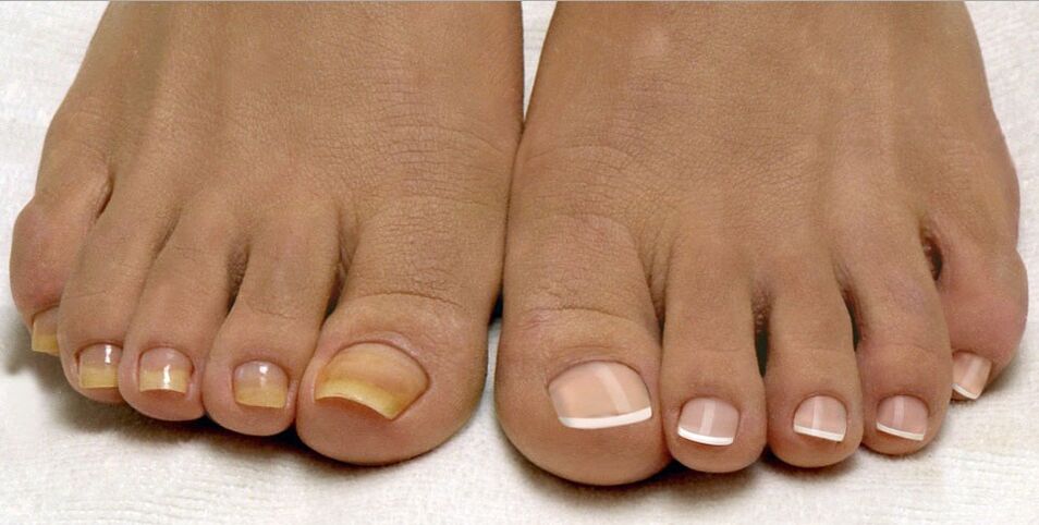zdravi nokti i gljivice na nogama