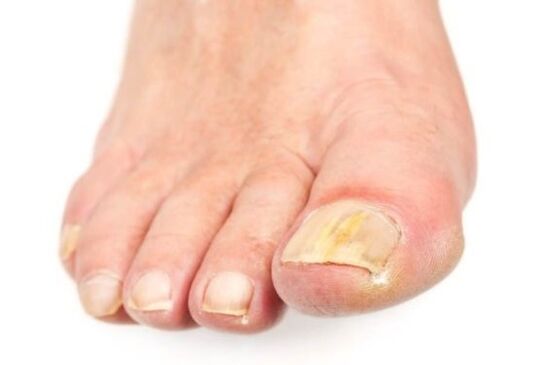 simptomi gljivica stopala