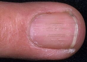 znakovi gljivica noktiju na nogama
