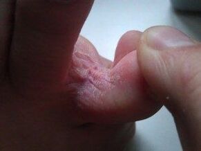 kožne lezije između prstiju s gljivicom