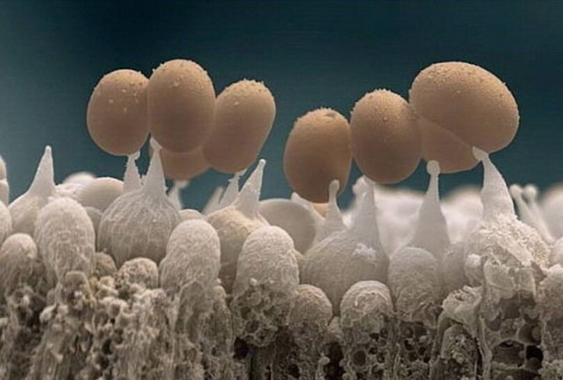 gljivice noktiju na nogama pod mikroskopom