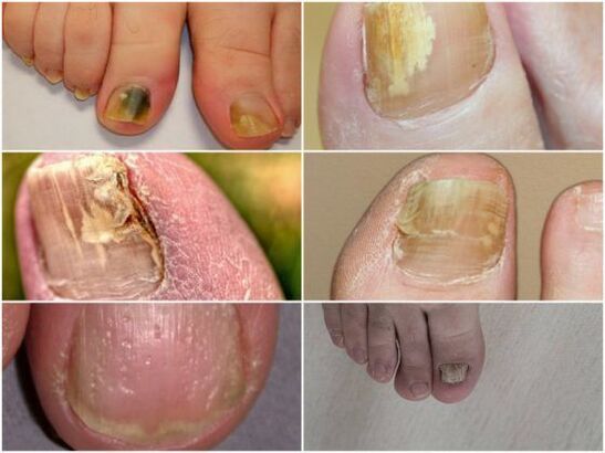 simptomi gljivične infekcije noktiju