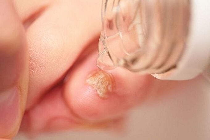liječenje gljiva na noktima nokta na noktima ocatom