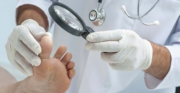 liječnik pregledava stopala zbog gljivica na noktima