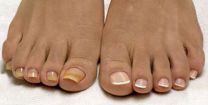 zdravi nokti na nogama i nokti zahvaćeni gljivicama