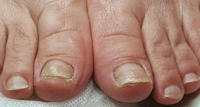 oštećenje noktiju gljivicama na nogama