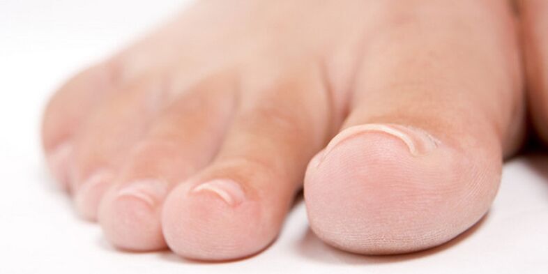 početna faza gljivice na noktima noktiju