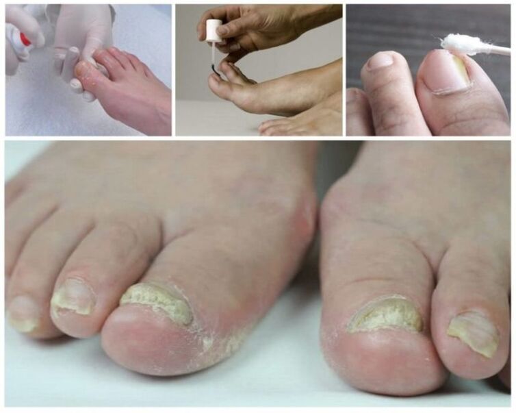 lijekovi za gljivice na noktima nogu