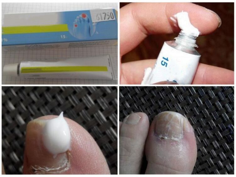 masti protiv gljivica na noktima noktiju