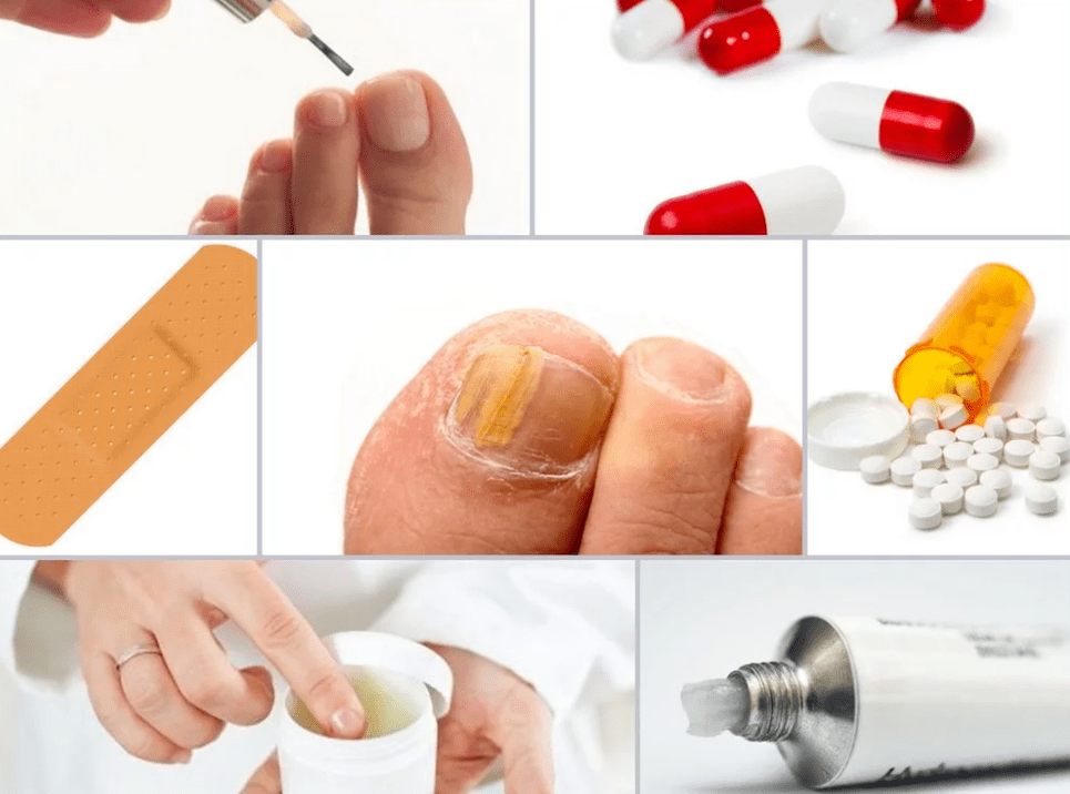 sistemski lijekovi za gljivice na noktima nogu
