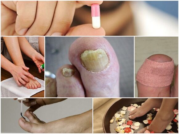 vrste lijekova za gljivice na noktima nogu