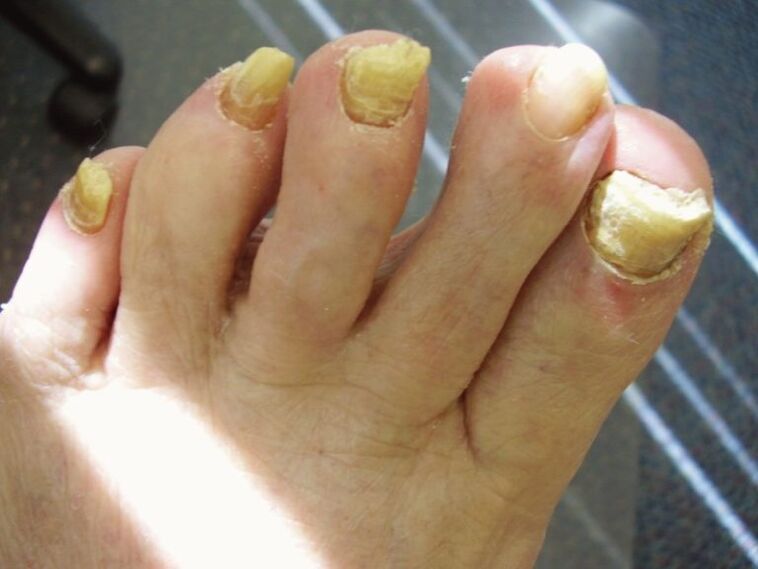 zanemarena gljiva nokta na noktima
