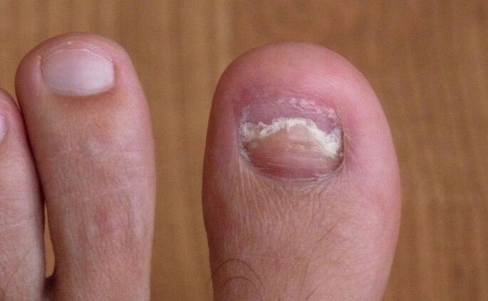 oštećenje nokta na nožnom palcu gljivicom