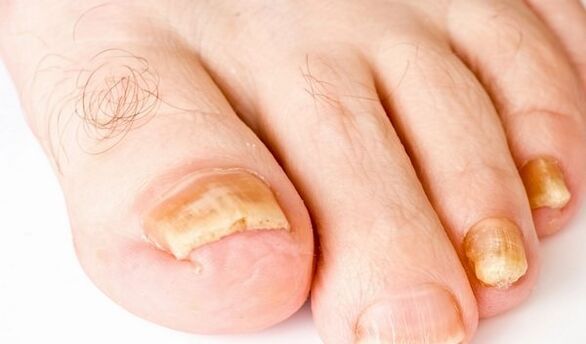 fotografija simptoma gljivice na noktima noktiju