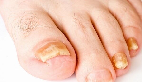 žuti nokti na nogama zbog gljivičnih infekcija